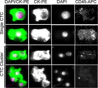 The Presence of Circulating Tumor Cell Cluster Characterizes an Aggressive Hepatocellular Carcinoma Subtype